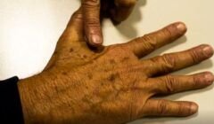 Desinformação sobre câncer de pele afeta diagnóstico, diz instituição