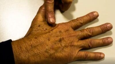 Desinformação sobre câncer de pele afeta diagnóstico, diz instituição