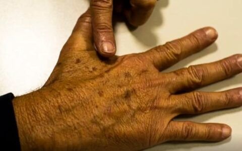 Desinformação sobre câncer de pele afeta diagnóstico, diz instituição