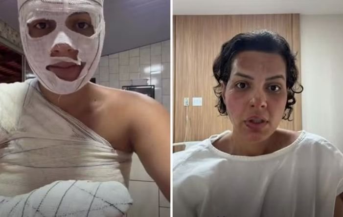 Nutricionista sofre queimaduras após explosão durante faxina