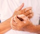 Vitiligo pode afetar autoestima e saúde mental, alerta dermatologista
