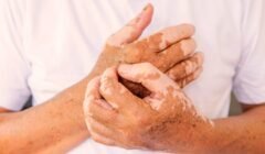 Vitiligo pode afetar autoestima e saúde mental, alerta dermatologista